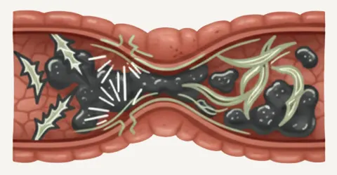Diagram illustrating how common fibers like Psyllium bind waste like glue, causing hardening, constipation, and painful bloating in the colon.