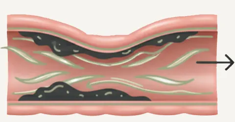 Diagram showing So Easy Oil Palm Fiber successfully penetrating hardened mucoid plaque, gently lubricating the colon wall for comfortable elimination within 3 days without cramping.