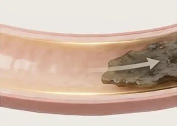 Diagram illustrating the gentle elimination of a large section of old, rubbery waste sliding out of the colon through the slippery channel, showing a clean release without cramping.
